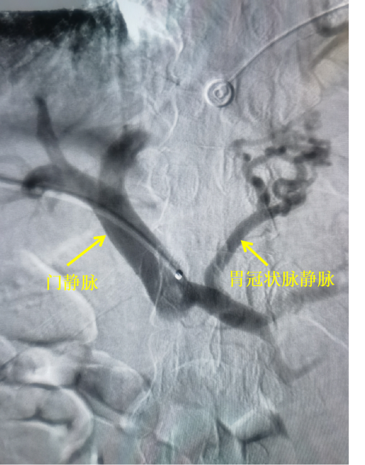 血管介入科救治一例肝硬化所致上消化道大出血患者 血管介入科救治一例肝硬化所致上消化道大出血患者