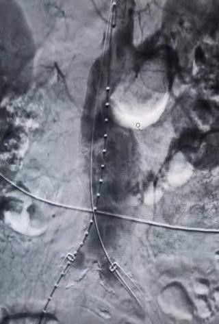 血管介入科完成一例腹主动脉瘤腔内修复术