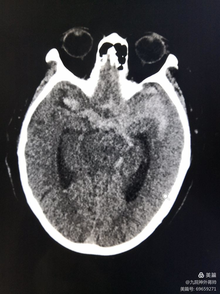 【急救直击】铭记历史不忘初心——神经外科西迁老师救治小记 【急救直击】铭记历史不忘初心——神经外科西迁老师救治小记