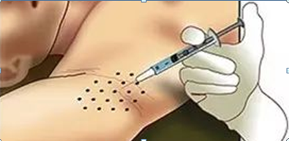 【特色治疗】摆脱“腋来香”