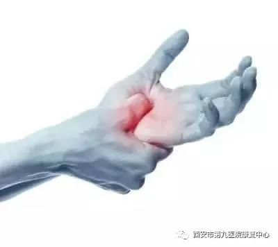 腕管综合征的康复治疗