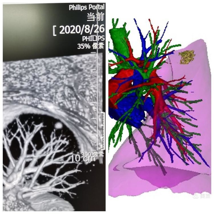 小结节不纠结,微创手术来解决 小结节不纠结,微创手术来解决