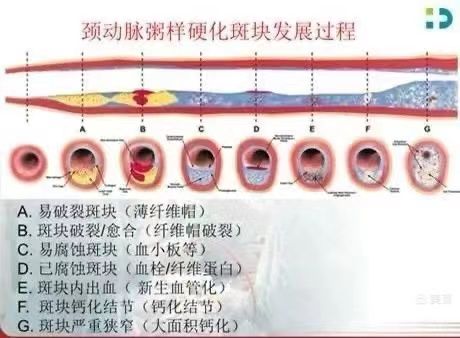 【健康科普】颈动脉斑块“不痛不痒”，该如何诊疗呢？