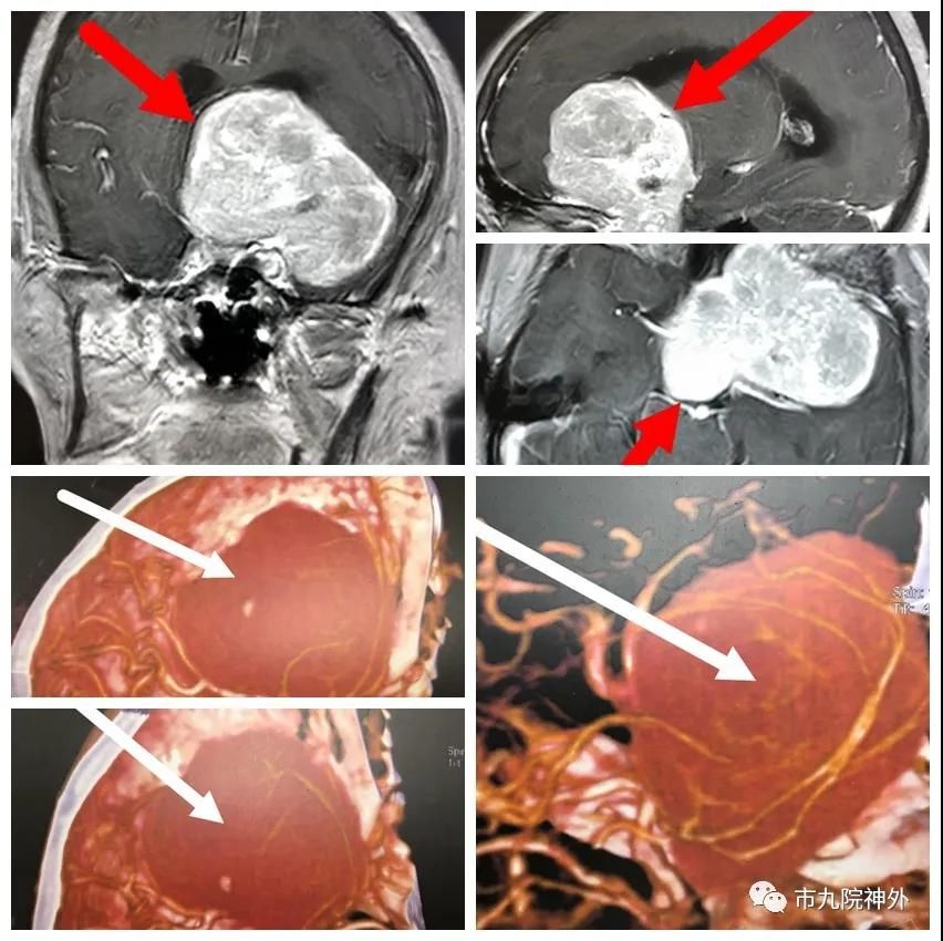 20小时的手术 20小时的手术
