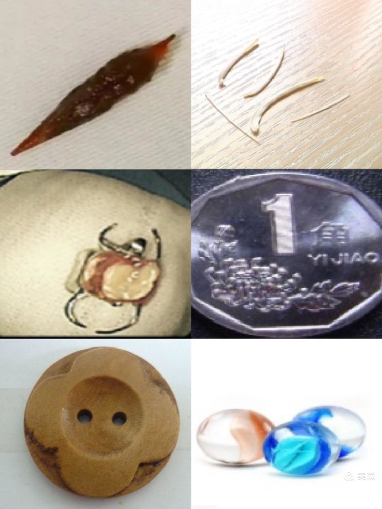 网篮在异物取出术中的应用