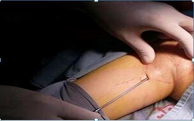 【特色治疗】摆脱“腋来香”