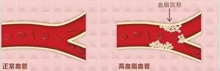 什么是高脂血症（一）？