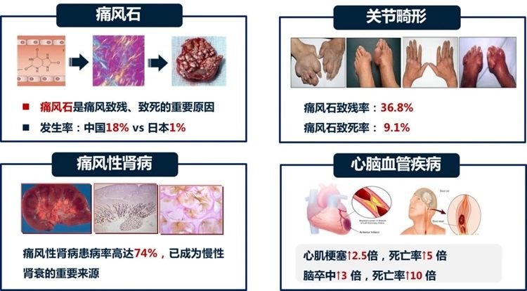 “精准防控,畅享生活”西安市第九医院内分泌科成功举办“世界痛风日”义诊活动 “精准防控,畅享生活”西安市第九医院内分泌科成功举办“世界痛风日”义诊活动
