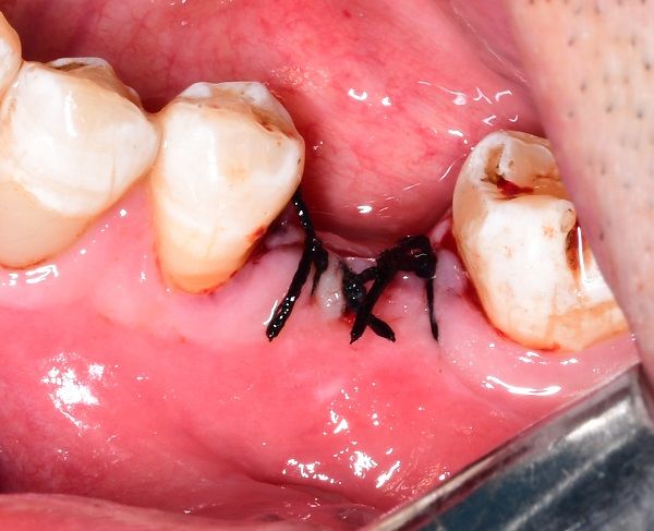 我院口腔科开展种植牙新技术 我院口腔科开展种植牙新技术