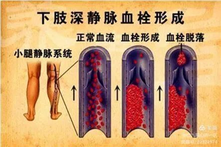 【健康科普】长途飞行会发生下肢深静脉血栓吗？