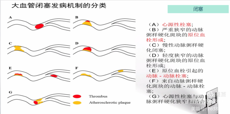 【特色技术】神经外科——球囊扩张及支架成形术治疗颅内动脉粥样硬化性狭窄（ICAS）
