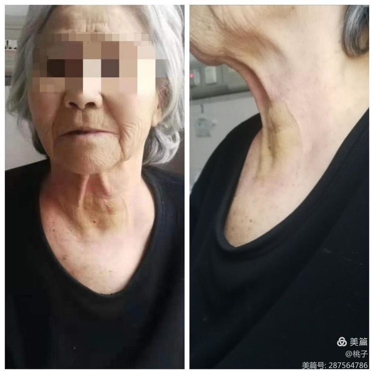 西安市第九医院胸外科甲状腺乳腺组为一名76岁聋哑女性行甲状腺微波消融术