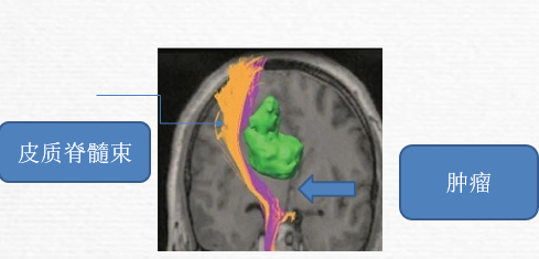 弥散张量成像在胶质瘤术中的应用