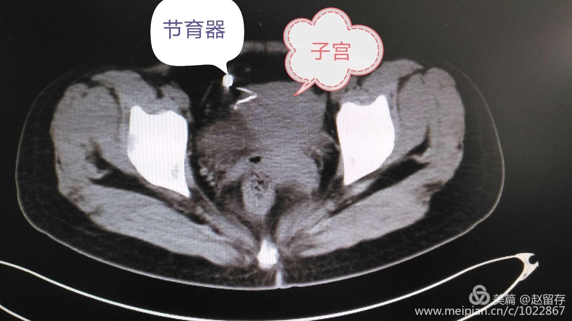 泌尿外科双镜联合治疗特殊膀胱结石