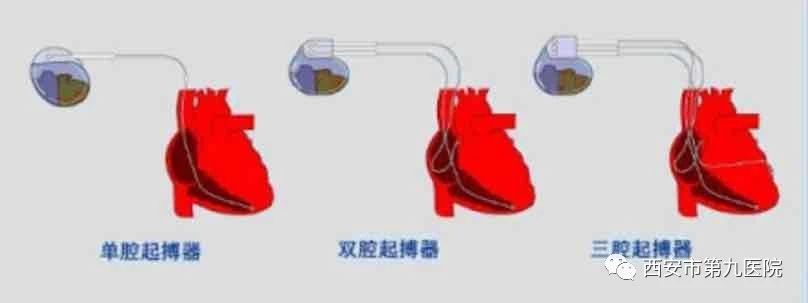 【科普速递】心脏起搏器~为生命续航 【科普速递】心脏起搏器~为生命续航