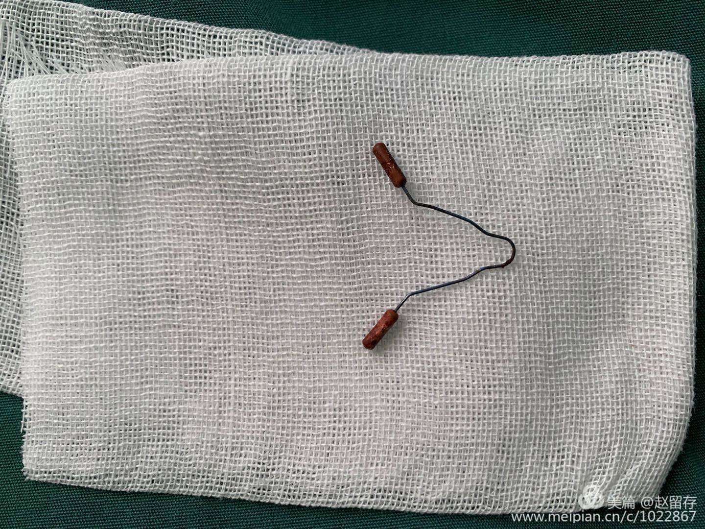 泌尿外科双镜联合治疗特殊膀胱结石