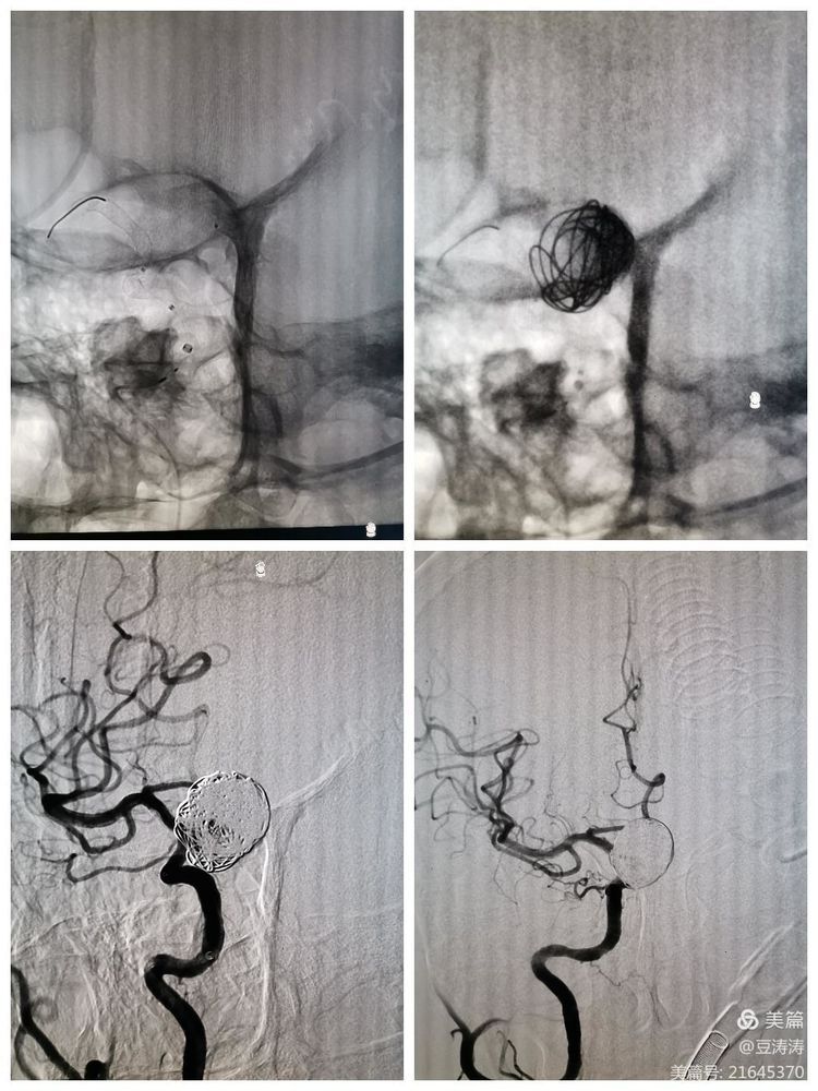 特色展示之九-血流导向装置在颅内复杂动脉瘤中的应用