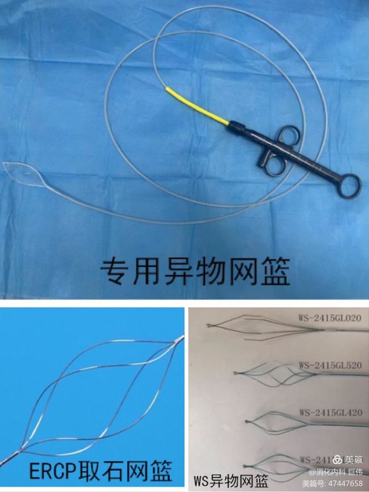 网篮在异物取出术中的应用