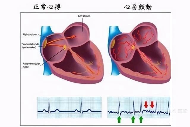 【科普园地】“颤动的心”如何安抚? 【科普园地】“颤动的心”如何安抚?