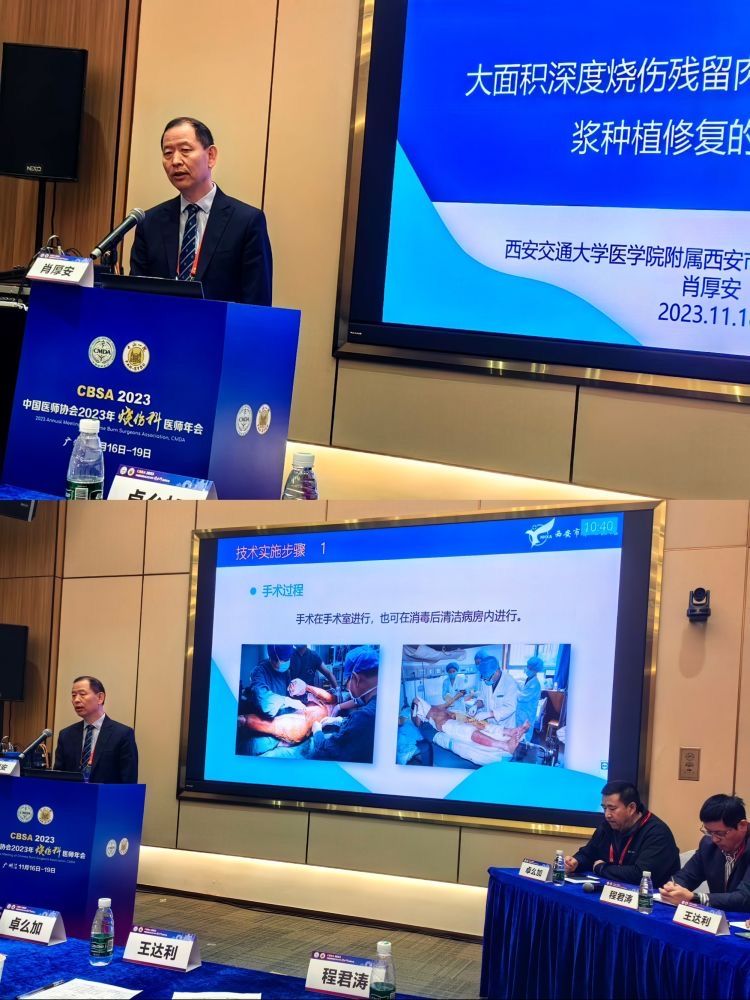 西安市第九医院自体微粒皮肉芽创面种植手术新方法在中国医师协会2023年烧伤科医师年会上报告交流引起同道关注 西安市第九医院自体微粒皮肉芽创面种植手术新方法在中国医师协会2023年烧伤科医师年会上报告交流引起同道关注