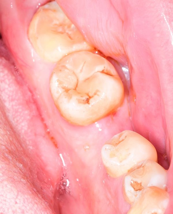 我院口腔科开展种植牙新技术 我院口腔科开展种植牙新技术