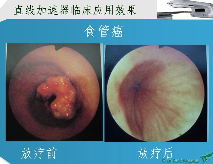 西安市第九医院放疗科开展放射治疗讲座
