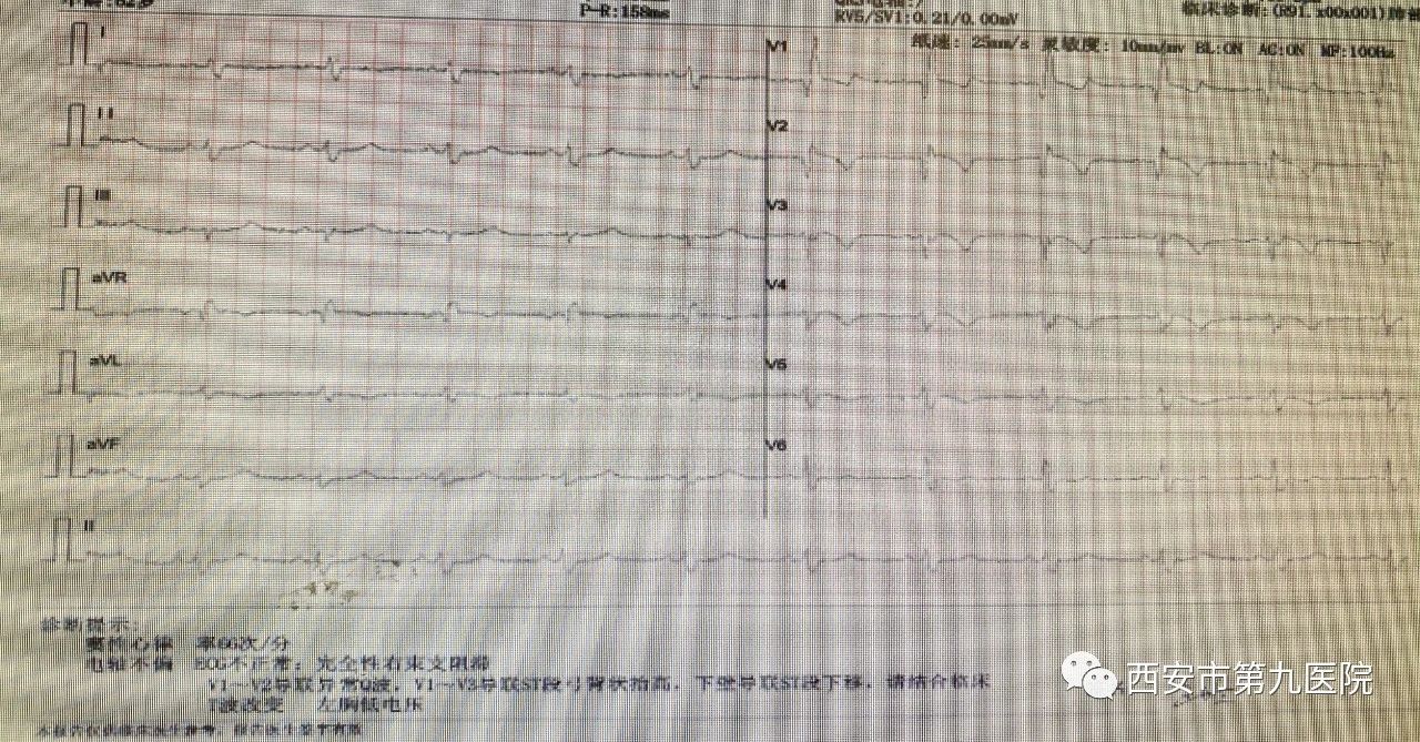 医路前行,“醉”美守护——一例高危全麻支气管镜检术 医路前行,“醉”美守护——一例高危全麻支气管镜检术