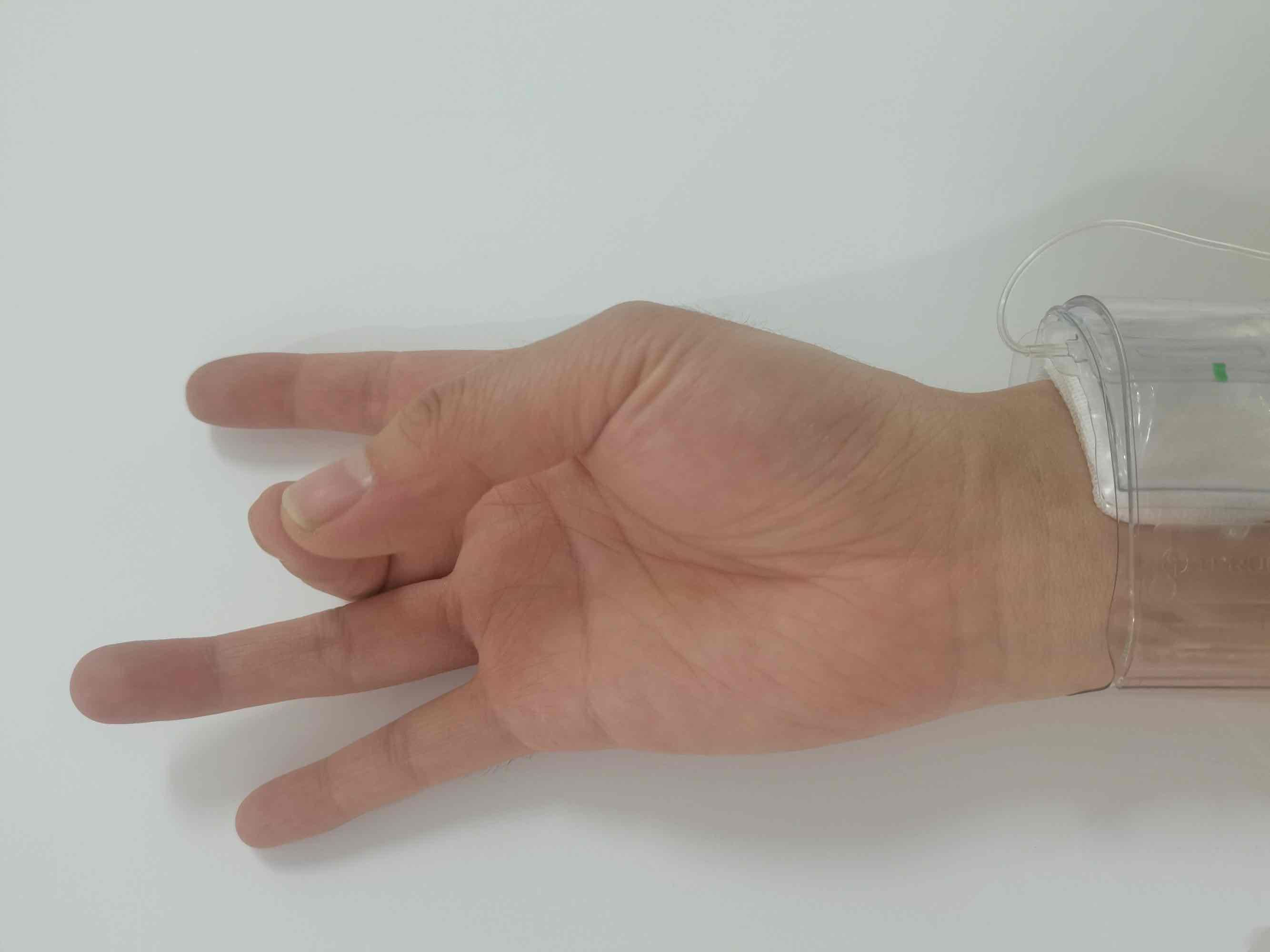 小小手指操，解决介入术后患者大问题