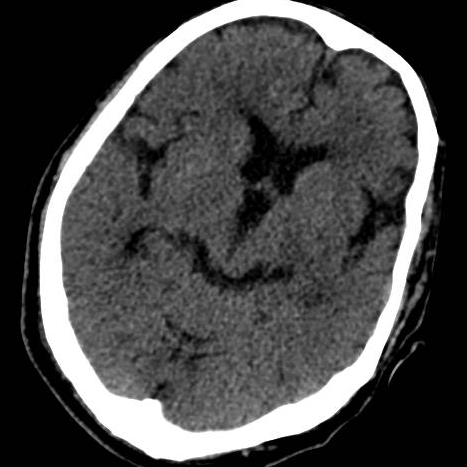 【医疗技术】神内卒中团队开通基底动脉1例 【医疗技术】神内卒中团队开通基底动脉1例