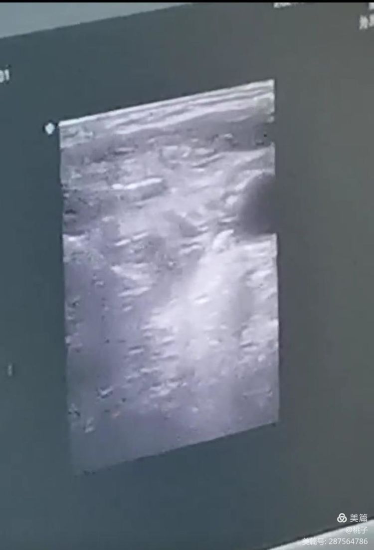 西安市第九医院胸外科甲状腺乳腺组为一名76岁聋哑女性行甲状腺微波消融术