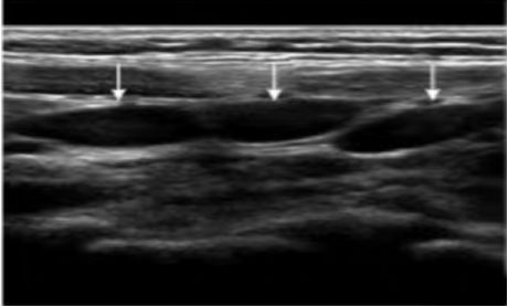 有一种腹痛叫肠系膜淋巴结炎 有一种腹痛叫肠系膜淋巴结炎