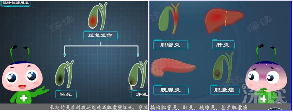 【科普知识】带您了解胆结石