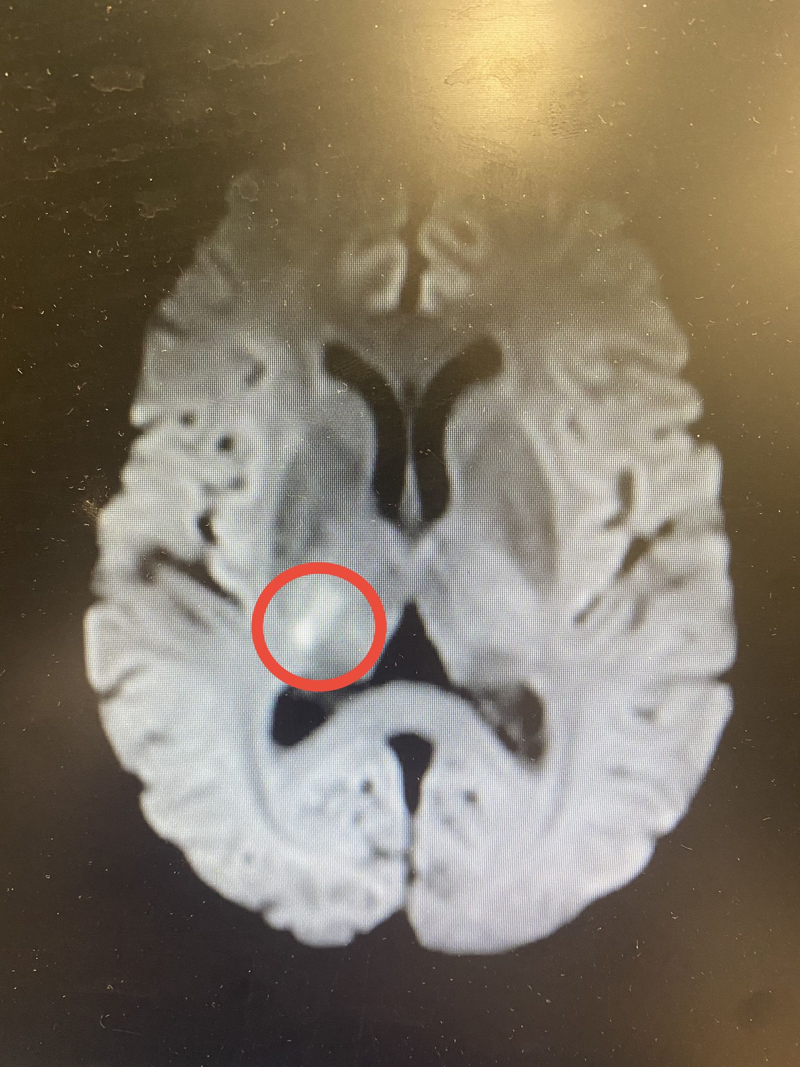 ADAPT技术快速开通颅内动脉栓塞一例 ADAPT技术快速开通颅内动脉栓塞一例
