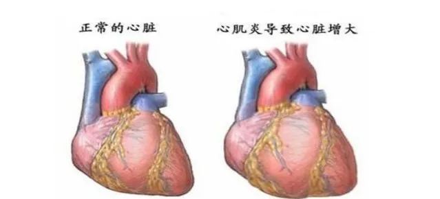 【健康科普】心肌炎患者应该注意什么? 【健康科普】心肌炎患者应该注意什么?