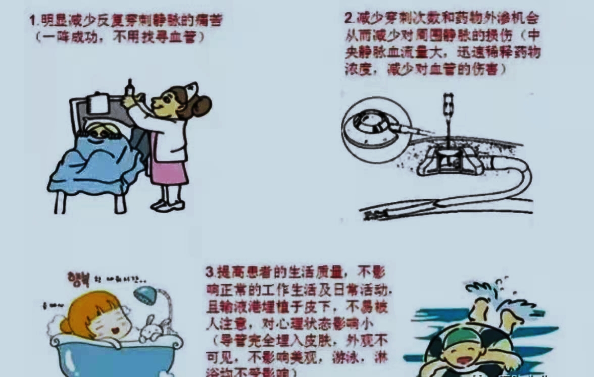 如何正确使用输液港 如何正确使用输液港