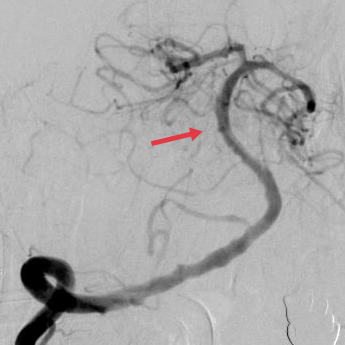 【医疗技术】神内卒中团队开通基底动脉1例 【医疗技术】神内卒中团队开通基底动脉1例