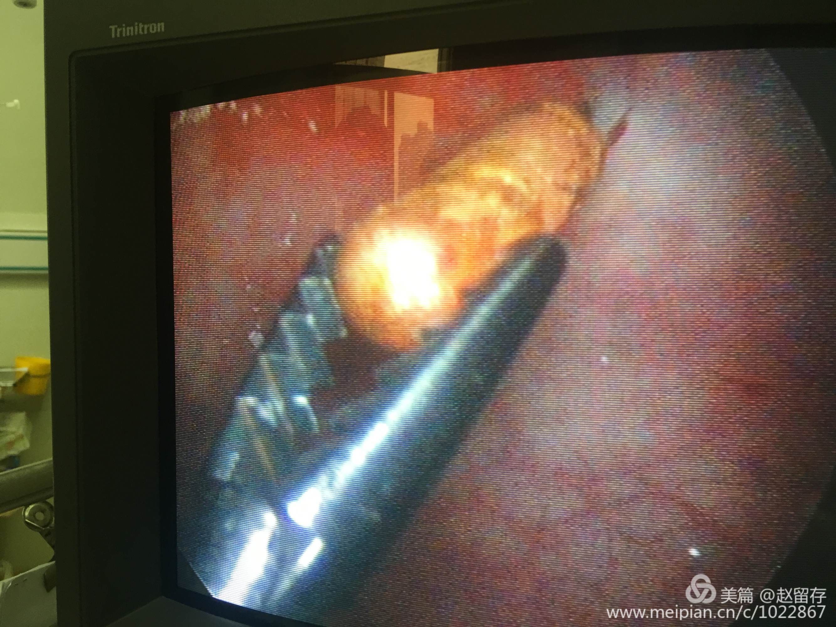 泌尿外科双镜联合治疗特殊膀胱结石