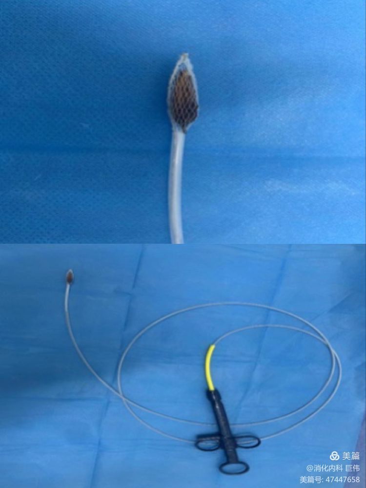 网篮在异物取出术中的应用