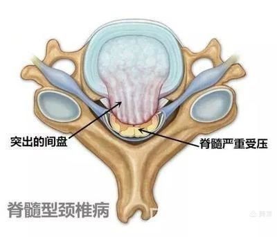 【科普园地】颈椎病篇二:认识颈椎病 【科普园地】颈椎病篇二:认识颈椎病