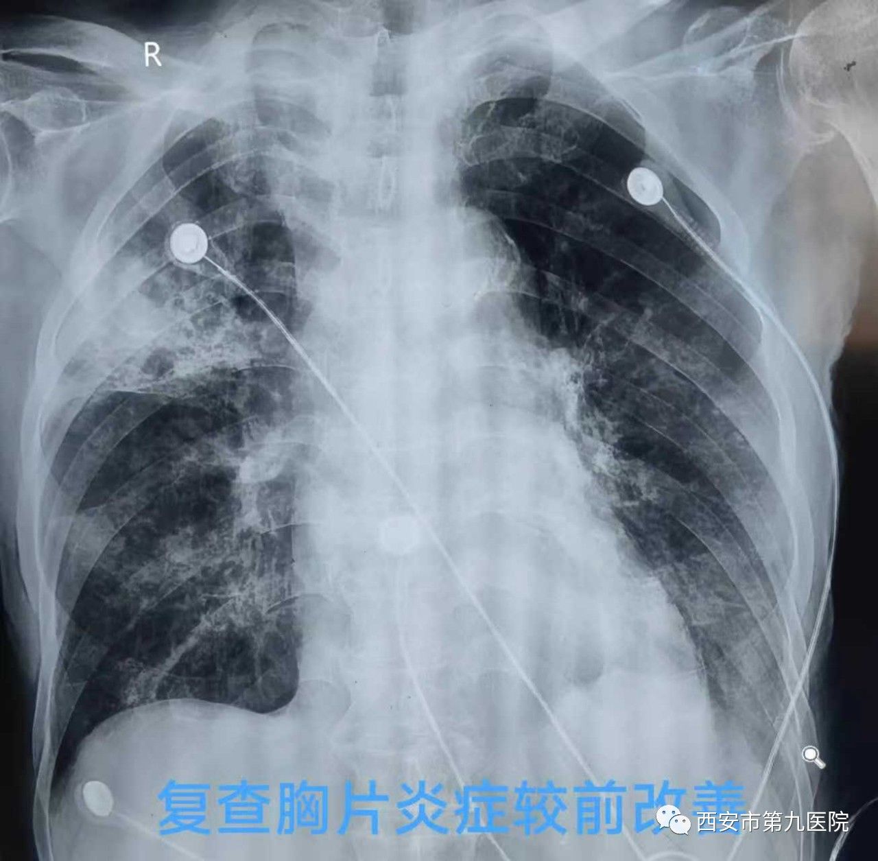 【科室动态】拯救“白肺”加“白脑”的八旬老人 【科室动态】拯救“白肺”加“白脑”的八旬老人