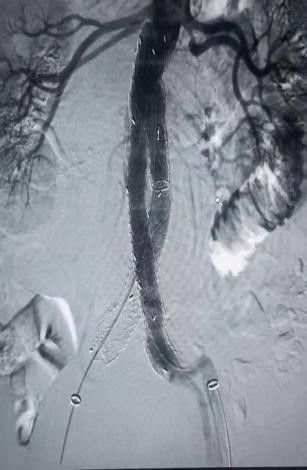 血管介入科完成一例腹主动脉瘤腔内修复术