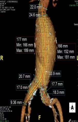 血管介入科完成一例腹主动脉瘤腔内修复术