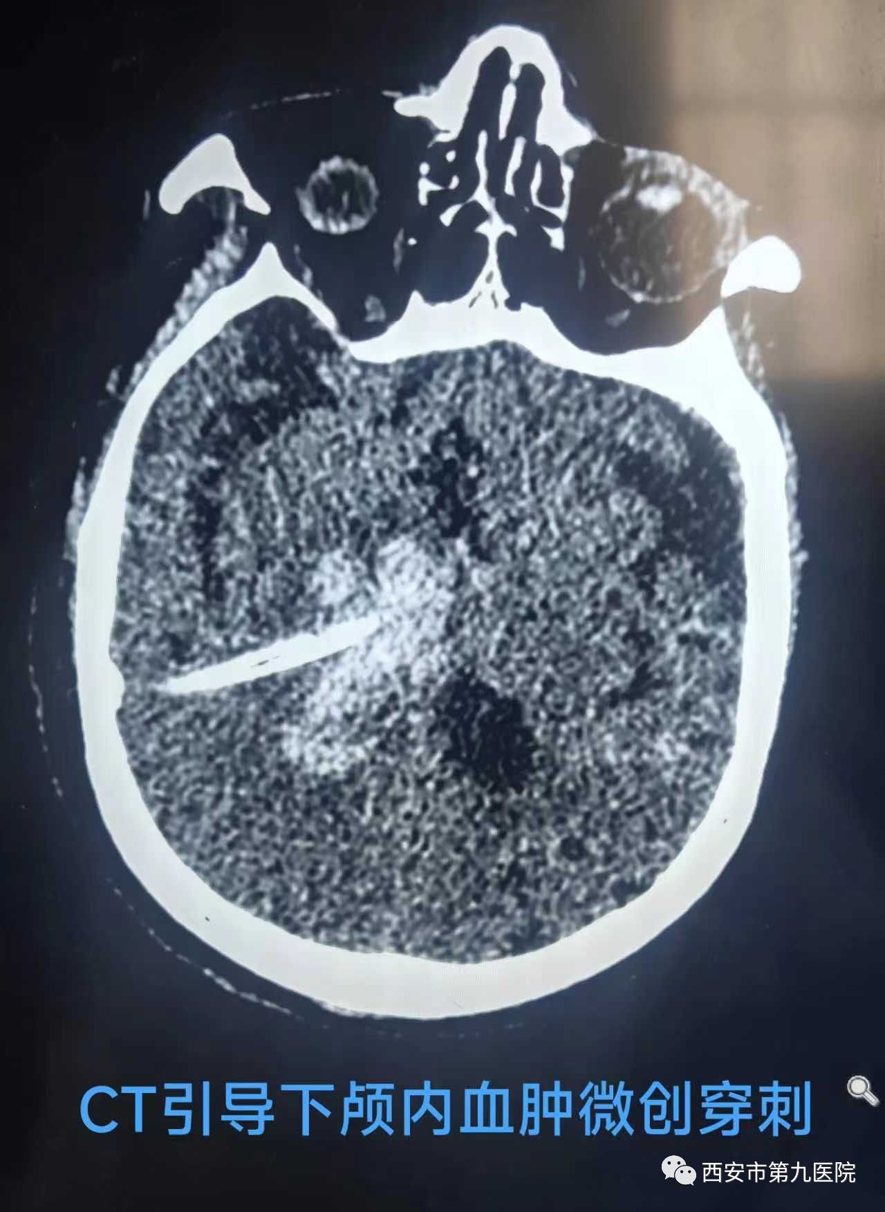 【科室动态】拯救“白肺”加“白脑”的八旬老人 【科室动态】拯救“白肺”加“白脑”的八旬老人