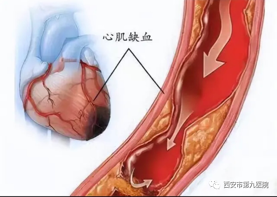 【健康科普】心肌缺血了,怎么办? 【健康科普】心肌缺血了,怎么办?