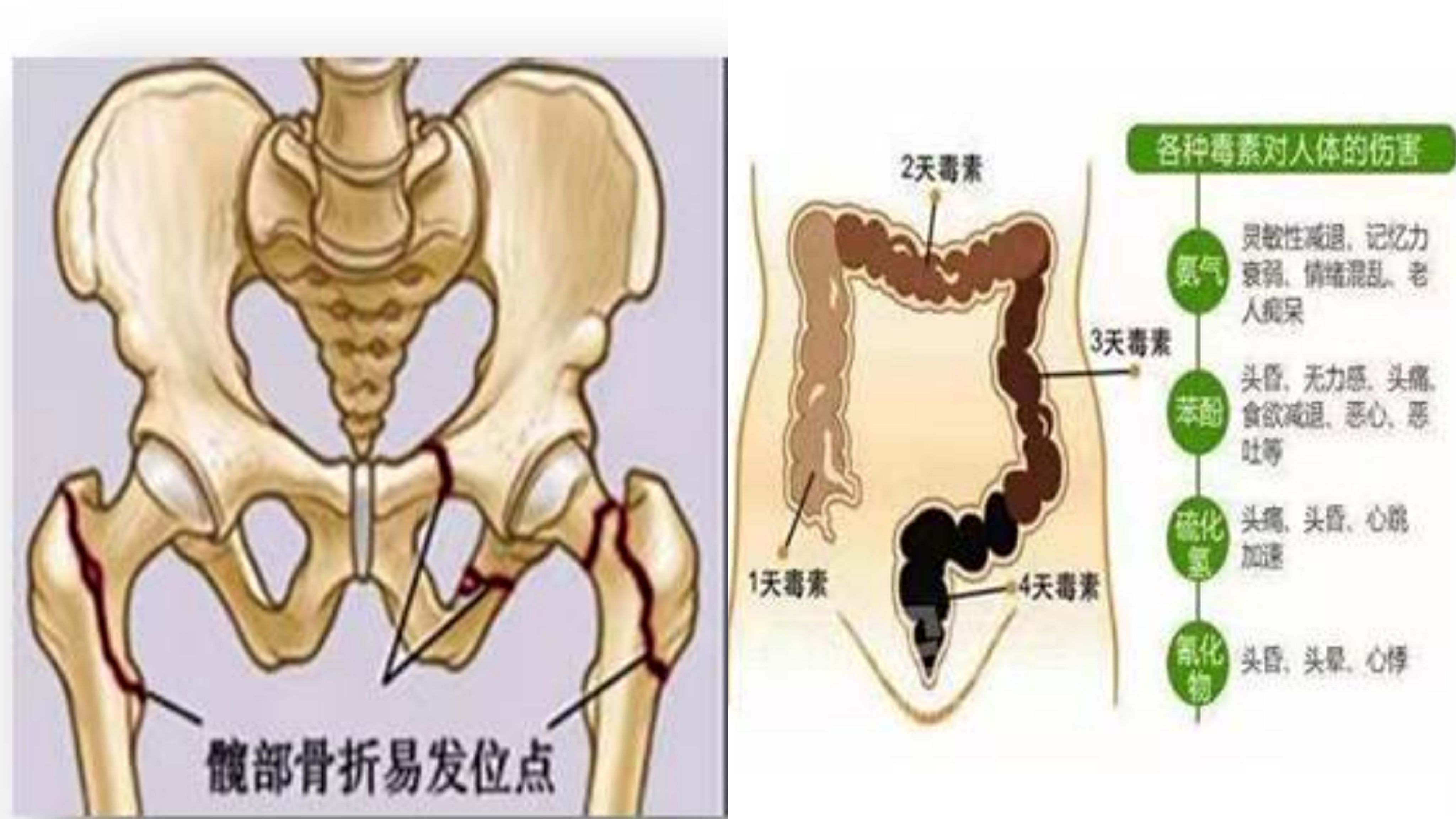 中西医结合体系化管理降低髋部骨折患者便秘的发生率