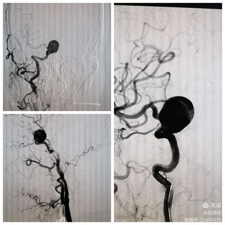 特色展示之九-血流导向装置在颅内复杂动脉瘤中的应用
