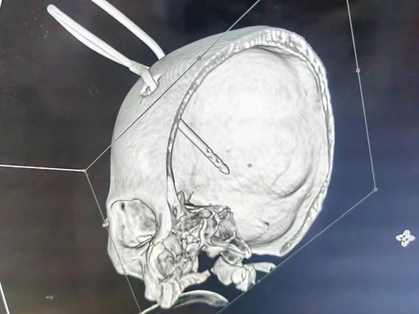 【典型病例】摔倒了可不一定就是外伤,小心“炸弹”来袭 【典型病例】摔倒了可不一定就是外伤,小心“炸弹”来袭