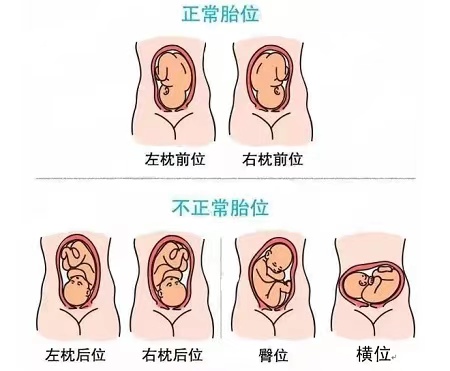 惊心动魄!产妇突发脐带脱垂,妇产科团队上演急速救援 惊心动魄!产妇突发脐带脱垂,妇产科团队上演急速救援