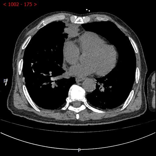 不开刀杀肿瘤：血管介入科开展首例CT引导下肺恶性肿瘤射频消融术