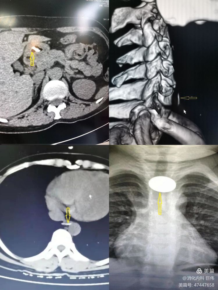 网篮在异物取出术中的应用